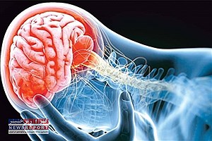 تشخیص سریع سکته مغزی: نشانه‌های حیاتی را بشناسید